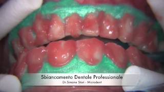 Sbiancamento Professionale dei Denti Teeth Whitening [upl. by Jeannine]