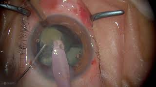 Surgery Phacoemulsification in Posterior Subcapsular Cataract [upl. by Assetan]