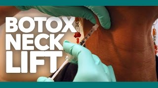 Botox Neck Lift  Botox for Neck Bands amp Platysma Muscles  Los Angeles [upl. by Sacul395]