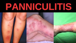 WHAT IS PANNICULITIS SYMPTOMS CAUSES TREATMENT [upl. by Garretson]