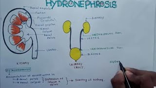 HYDRONEPHROSIS  Pathophysiology Causes signs and symptoms background diagnosis and treatment [upl. by Johanna]