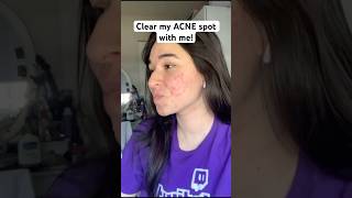 Clear my acne with me🤌 acne skin skincare skincareroutine shorts clearskin [upl. by Aderf164]