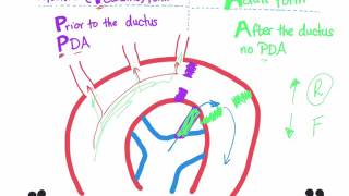 Coarctation of aorta Infantile type vs adult type mnemonic [upl. by Evans]