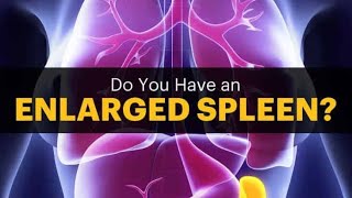 Splenomegaly Enlarged Spleen Splenitits Treatment and Cure [upl. by Kelbee]