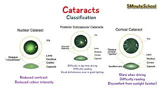 TYPES OF CATARACT  CORTICAL VS NUCLEAR VS POSTERIOR SUBCAPSULAR [upl. by Odele]