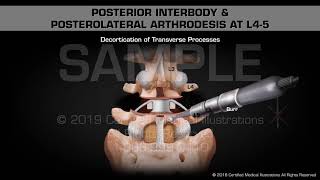 Posterior Interbody amp Posterolateral Arthrodesis at L45  Medical Animation [upl. by Aicelf]