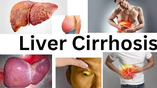 Liver CirrhosisAmharic Tutorial [upl. by Dyoll]