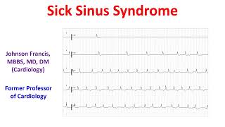 Sick Sinus Syndrome [upl. by Ayotnahs680]