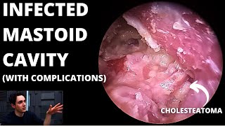 Infected Mastoid Cavity With Cholesteatoma Condylectomy May Be Needed [upl. by Stallworth]