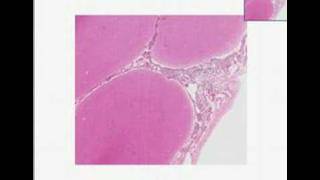 Histopathology Brain Acute pyogenic bacterial meningitis [upl. by Alyakam]