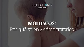 Moluscos qué los ocasiona y cómo tratarlos  Consultorio bbmundo [upl. by Valeda747]