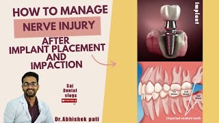 HOW TO MANAGE NERVE INJURY AFTER PLACING IMPLANTS [upl. by Silloh]