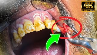 UNBELIEVABLE 20 Years Without Brushing Teeth  Extraction of Premolar Tooth Using Forceps [upl. by Kenrick]