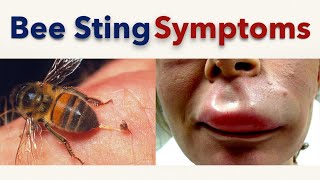 Bee Sting Symptoms [upl. by Eniamirt]