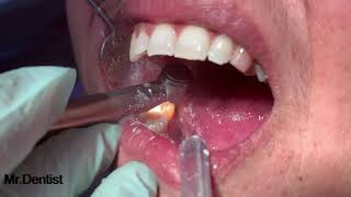 Root Canal Treatment  Part 2 [upl. by Boeke55]