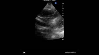 POCUS tamponade [upl. by Niatsirhc]