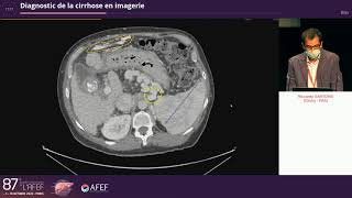 Diagnostic de la cirrhose en imagerie  R Sartoris [upl. by Ahsad598]