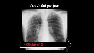 unclichéthoraciqueparjour  interprétation radiologique type emphysème pulmonaire diffus [upl. by Nooj]