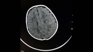 Mild cerebral atrophy Leukodystrophy [upl. by Anomahs]