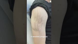 Laser tattoo removal results lasertattooremoval beforeandafter skincare tattoos satisfying [upl. by Names]