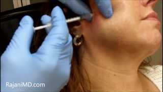 Watch Botox Facial Shaping and TMJRajani [upl. by Allemac]