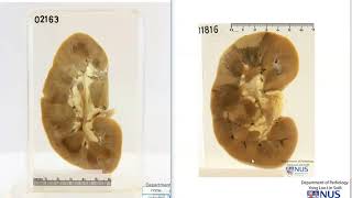 Kidney  Cortical Necrosis [upl. by Anaujd519]