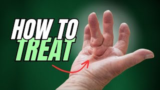 Dupuytrens Contracture Starts as Lump on Hand How to Treat [upl. by Eilyk]