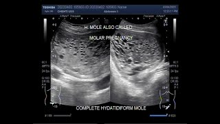 A case of complete Hydatidiform Mole [upl. by Sillyrama]