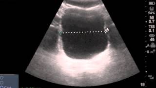 Ultrasound Estimated PostVoid Residual Bladder [upl. by Ellehctim95]