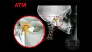 ATM Odontologia® Articulación Temporomandibular [upl. by Edlyn]