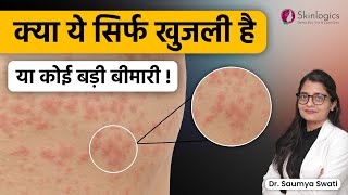 Skin allergy kyun hoti hai  Urticaria treatment  Best Skin Specialist in Noida [upl. by Naarah122]