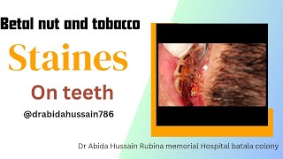 5 Years Without Brushing Teeth 😦 Calculus Removaldrabidahussain786dentistry drabidahussain786 [upl. by Navis]