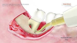 PIEZOSURGERY®  Dr Fabrizio Fontanella  Impacted third molar extraction technique [upl. by Nirrat]