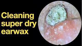 Cleaning super dry earwax ear wax removal  ear cleaning  ASMR  relaxation  relax [upl. by Ibbob]