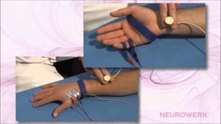 Sensory Neurography  Median Nerve [upl. by Sheff]