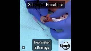 Subungual Hematoma Trephination [upl. by Ennayoj]