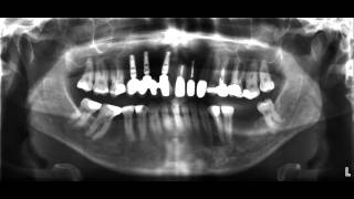 für Zahnärzte das OPTG Röntgen [upl. by Lilak699]