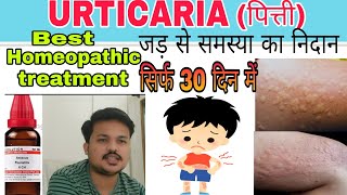 URTICARIAपित्ती Best homeopathic medicine for urticaria खुजली को कहो अलविदा urticaria treatment [upl. by Florette]