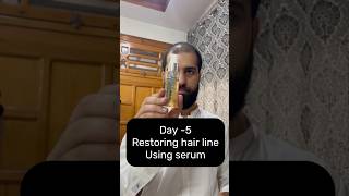 Restoring Hair Line Day5 using serum hairregrowth haircareroutine [upl. by Nevil]