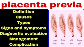 placenta previa [upl. by Penman690]