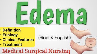 Edema  Edema In Hindi  Oedema [upl. by Gamali]