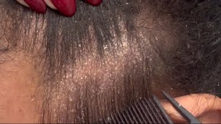 Flaky Eczema Scalp extreme close up ASMR [upl. by Sirama]