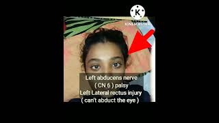 Left abducens nerve  CN 6  palsy [upl. by Lauren]