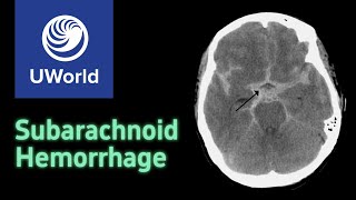 Subarachnoid Hemorrhage amp Treatment  nimodipine USMLE STEP 1 UWORLD Questions Nervous system [upl. by Mulry]