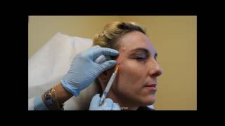 Temple Volume Restoration with Filler Injection [upl. by Hedley]