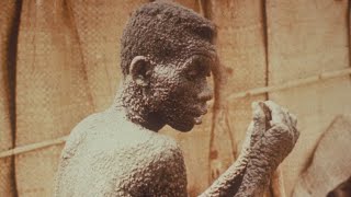 The HORRIFYING History of Smallpox [upl. by Dilisio]