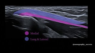 Triceps rupture ultrasound [upl. by Mali532]