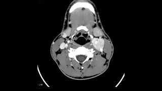 Paraganglioma do corpo carotídeo [upl. by Patrich]