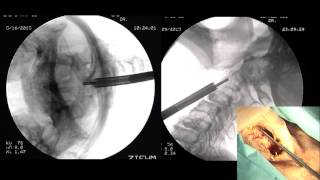 Odontoid Screw Fixation by Rick C Sasso MD [upl. by Tema254]