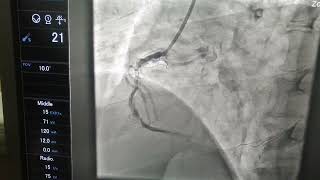 Obese patient BMI 36 with AcIWMI15amp 2 baloon Nc 25 pre balooning Buddy wire Primary pci [upl. by Ormond110]